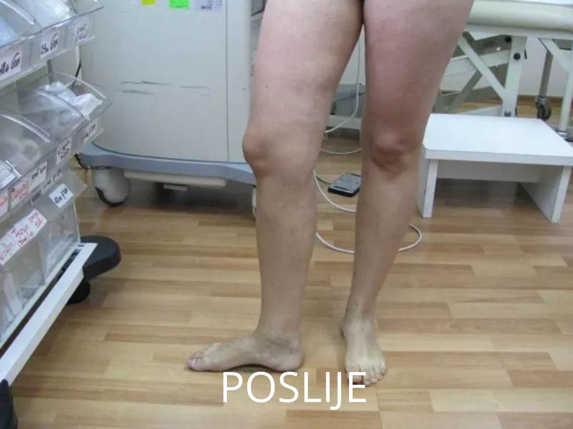 Proširene vene liječenje