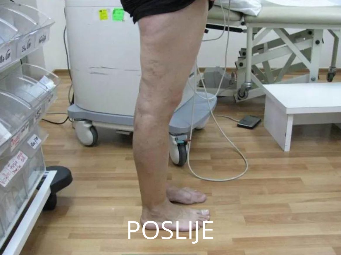 Proširene vene na nogama