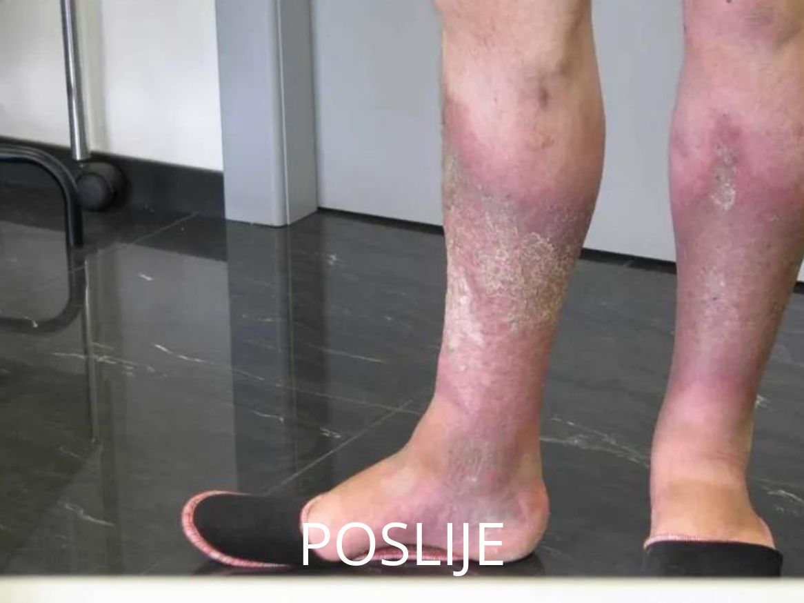 Najučinkovitija metoda liječenja proširenih vena