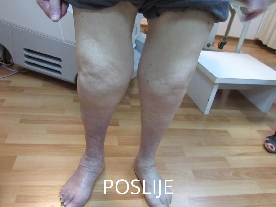 liječenje proširenih vena